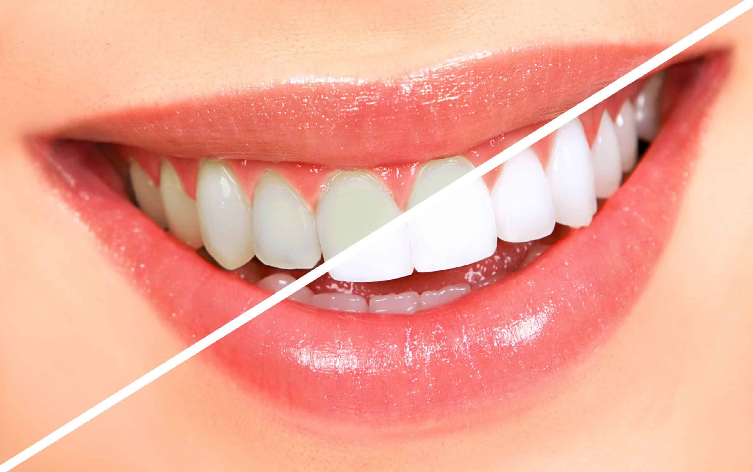 نحوه سفید کردن دندان ها در خانه