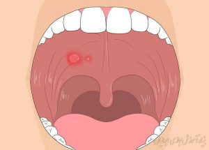 راه های خلاصی از شرّ تاول های دهان